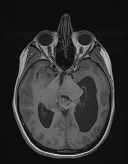 File:Central neurocytoma (Radiopaedia 84497-99872 Axial T1 88).jpg