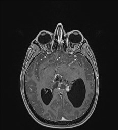 File:Central neurocytoma (Radiopaedia 84497-99872 Axial T1 C+ 73).jpg