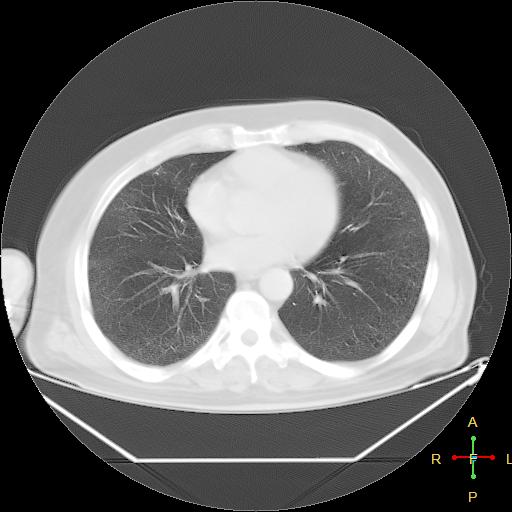 File:Centrilobular emphysema - with superimposed infection (Radiopaedia 24389-24683 lung window 18).jpg