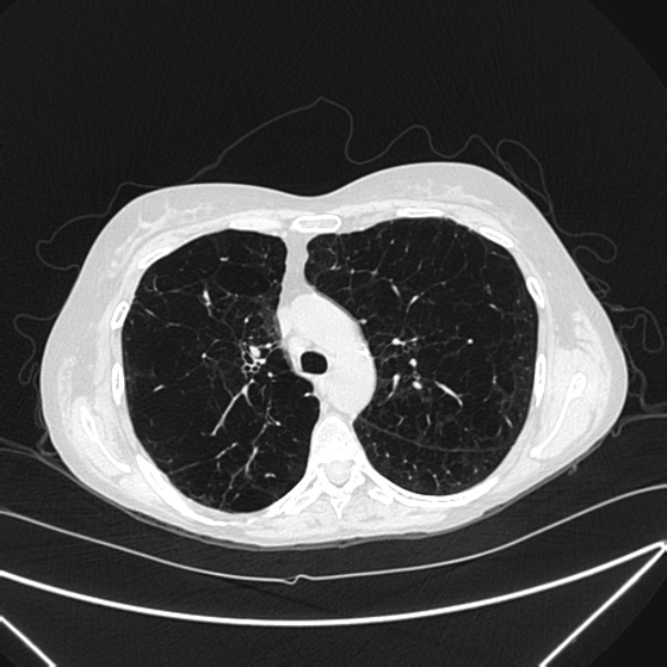 Centrilobular pulmonary emphysema (Radiopaedia 24495-24789 Axial lung window 33).jpg