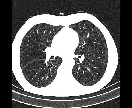 Centrilobular pulmonary emphysema (Radiopaedia 62468-70718 Axial lung window 41).jpg