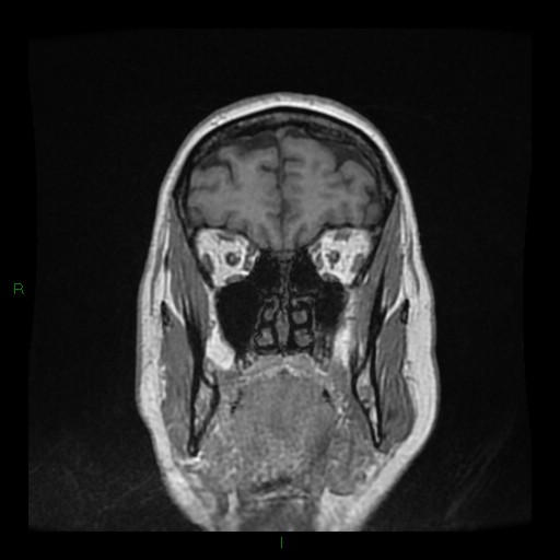 Cerebellar abscess (Radiopaedia 78135-90678 Coronal T1 C+ 31).jpg