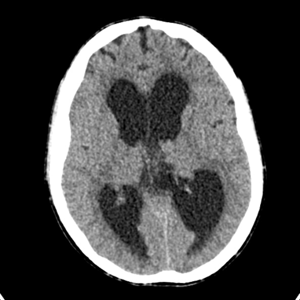 Cerebellar abscess secondary to mastoiditis (Radiopaedia 26284-26412 Axial non-contrast 83).jpg