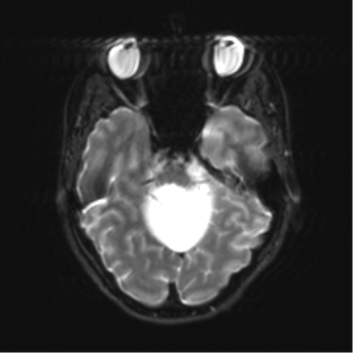 Cerebellar agenesis with hypoplastic pons (pontocerebellar hypoplasia) (Radiopaedia 57224-64138 Axial DWI 13).png