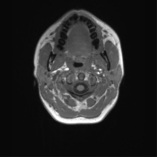 Cerebellar agenesis with hypoplastic pons (pontocerebellar hypoplasia) (Radiopaedia 57224-64138 Axial T1 1).png