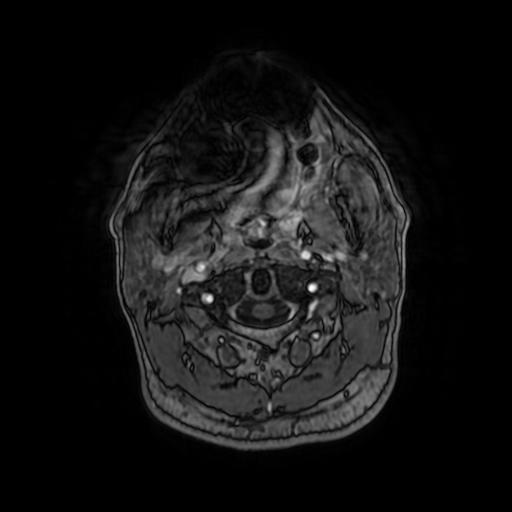 Cerebellar hemangioblastoma (Radiopaedia 88055-104622 Axial T1 C+ 11).jpg