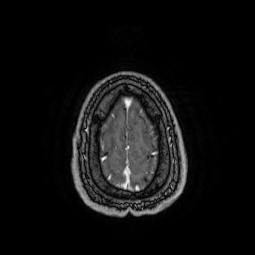 Cerebellar hemangioblastoma (Radiopaedia 88055-104622 Axial T1 C+ 157).jpg