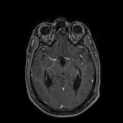 Cerebellar hemangioblastoma (Radiopaedia 88055-104622 Axial T1 C+ 85).jpg