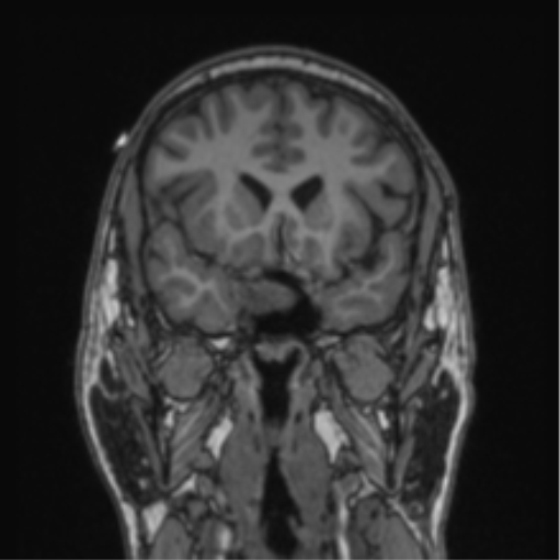 File:Cerebellar hemangioblastomas and pituitary adenoma (Radiopaedia 85490-101176 Coronal T1 61).png