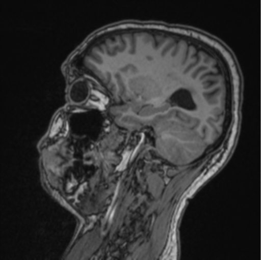 Cerebellar hemangioblastomas and pituitary adenoma (Radiopaedia 85490-101176 Sagittal T1 40).png