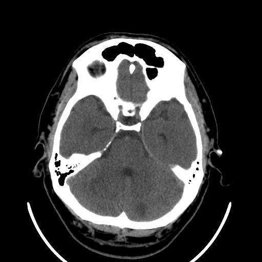 File:Cerebellar infarction (Radiopaedia 16625-16327 Axial non-contrast 13).jpg