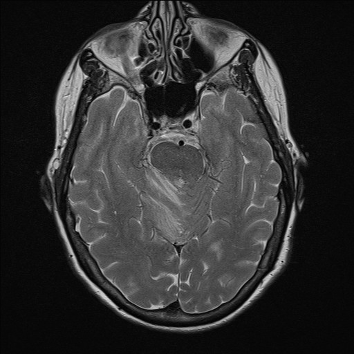 File:Cerebellar metastases (Radiopaedia 24038-24249 Axial T2 6).jpg