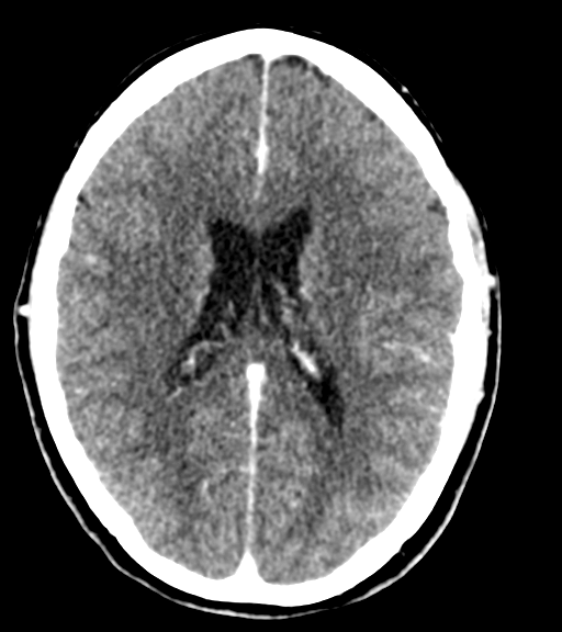 File:Cerebellar metastases - colorectal adenocarcinoma (Radiopaedia 40947-43652 Axial C+ 36).png