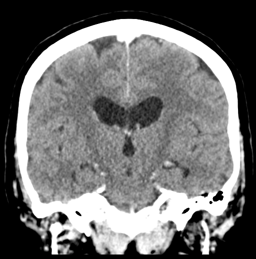 Cerebellar metastasis (Radiopaedia 54578-60812 Coronal C+ 31).png