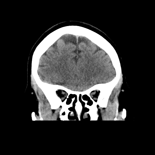 Cerebellar metastasis (cystic appearance) (Radiopaedia 41395-44258 Coronal non-contrast 19).png