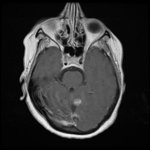File:Cerebellar metastasis (cystic appearance) (Radiopaedia 41395-44268 Axial T1 C+ 8).png
