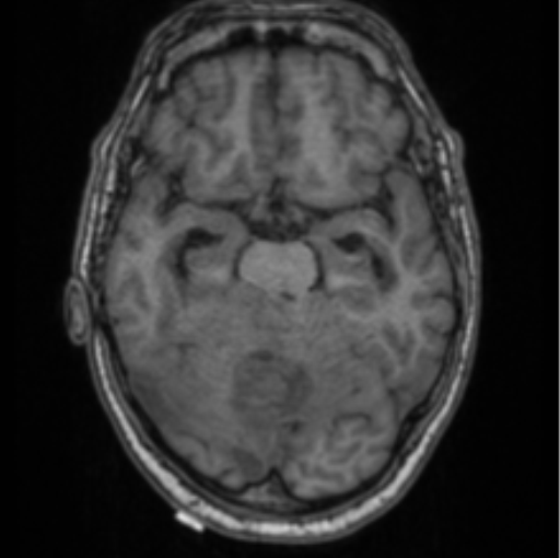 Cerebellar metastasis from lung adenocarcinoma (Radiopaedia 86690-102829 Axial T1 32).png