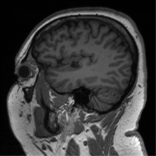 File:Cerebellopontine angle meningioma (Radiopaedia 48434-53348 Sagittal T1 25).png