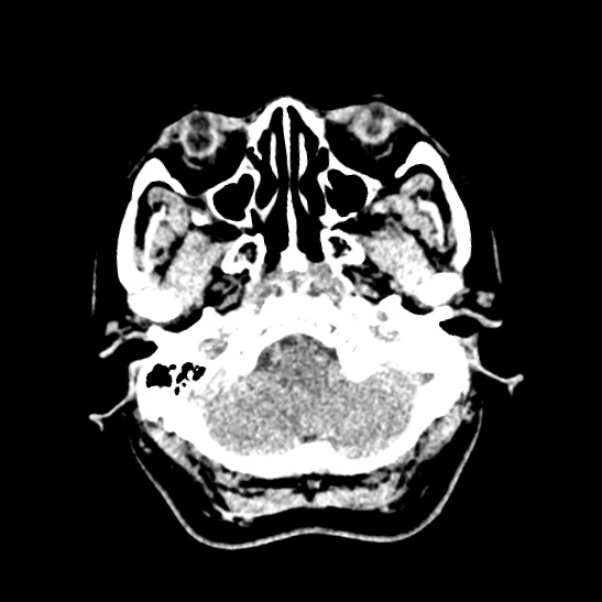 Cerebellopontine angle meningioma (Radiopaedia 53561-59592 Axial non-contrast 10).jpg