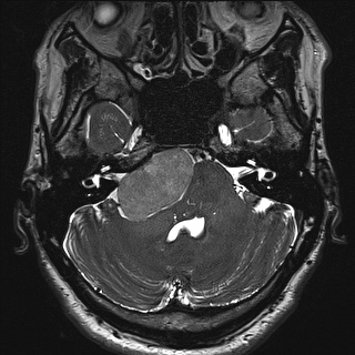 Cerebellopontine angle meningioma (Radiopaedia 72983-83680 Axial FIESTA 29).jpg