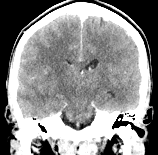 File:Cerebral abscess (Radiopaedia 60342-68008 Coronal C+ delayed 37).png