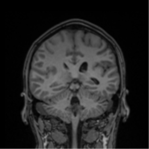 Cerebral abscess (Radiopaedia 60342-68009 Coronal T1 17).png