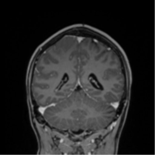 File:Cerebral abscess (Radiopaedia 60342-68009 H 13).png