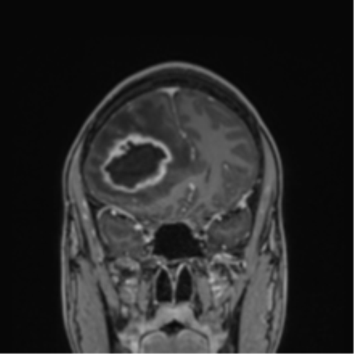 Cerebral abscess (Radiopaedia 60342-68009 H 37).png