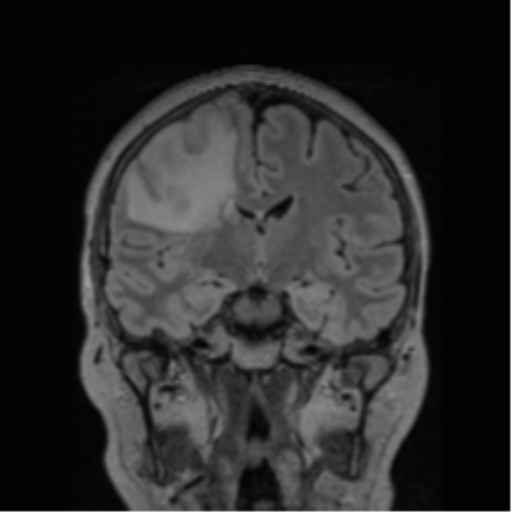 Cerebral abscess from pulmonary arteriovenous malformation (Radiopaedia 86275-102291 Coronal FLAIR 48).png