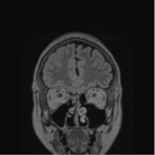 Cerebral abscess from pulmonary arteriovenous malformation (Radiopaedia 86275-102291 Coronal FLAIR 71).png