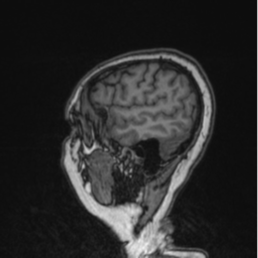Cerebral abscess from pulmonary arteriovenous malformation (Radiopaedia 86275-102291 Sagittal T1 28).png