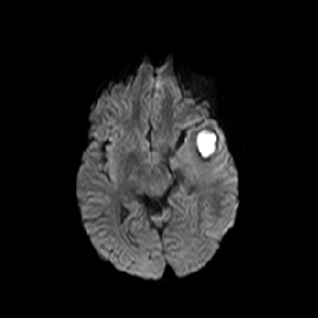 File:Cerebral abscess post cardiac surgery (Radiopaedia 27244-27420 Axial DWI 8).jpg