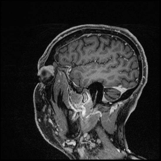 Cerebral abscess with ventriculitis (Radiopaedia 78965-91878 Sagittal T1 C+ 144).jpg