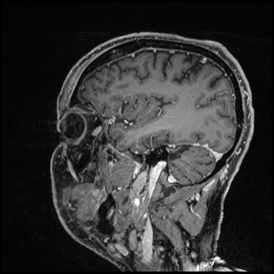 Cerebral abscess with ventriculitis (Radiopaedia 78965-91878 Sagittal T1 C+ 51).jpg