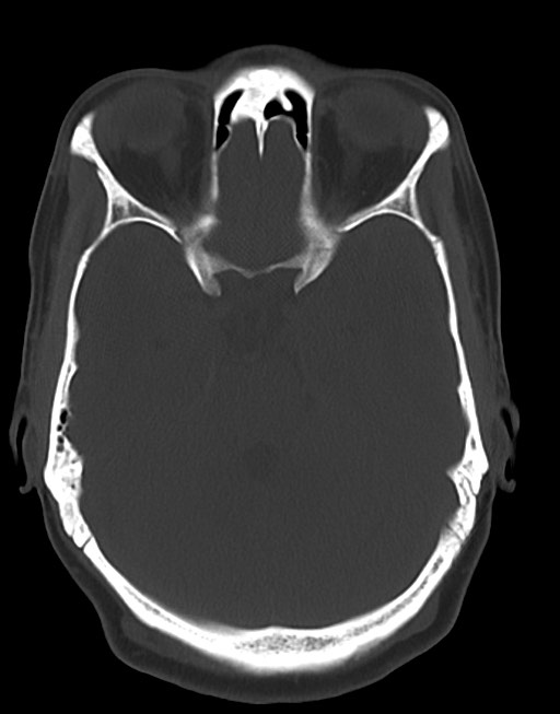 Cerebral abscesses (Radiopaedia 70458-80568 Axial bone window 23).jpg