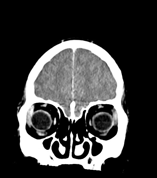 Cerebral abscesses (Radiopaedia 70458-80568 Coronal Contrast 14).jpg