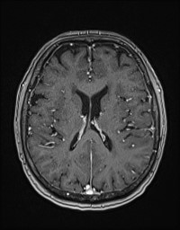 Cerebral amyloid angiopathy-related inflammation (Radiopaedia 58270-65377 Axial T1 C+ fat sat 87).jpg