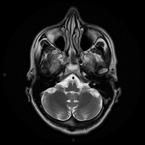 File:Cerebral amyloid angiopathy (Radiopaedia 77506-89664 Axial T2 7).jpg