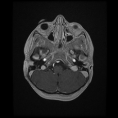 File:Cerebral and spinal tuberculosis (Radiopaedia 90489-107837 Axial T1 C+ 50).jpg