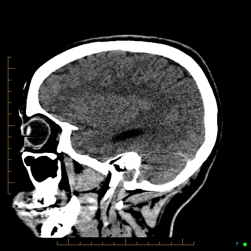 Cerebral arteriovenous malformation (AVM) (Radiopaedia 78162-90706 A 57).jpg
