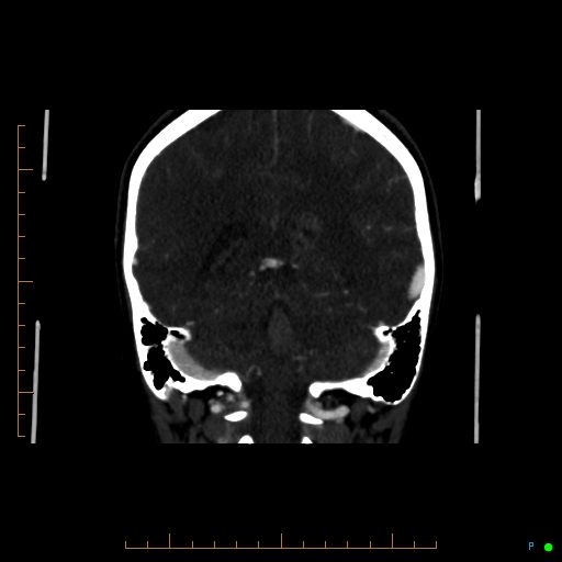 Cerebral arteriovenous malformation (AVM) (Radiopaedia 78162-90706 Coronal CTA 38).jpg
