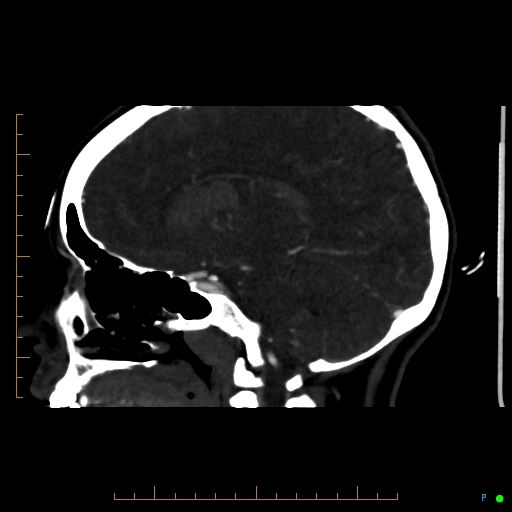 File:Cerebral arteriovenous malformation (AVM) (Radiopaedia 78162-90706 Sagittal CTA 36).jpg