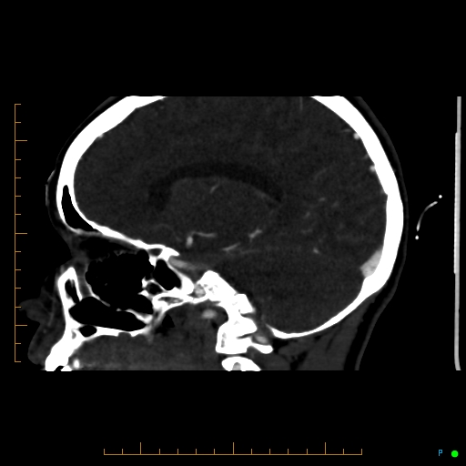Cerebral arteriovenous malformation (AVM) (Radiopaedia 78162-90706 Sagittal CTA 48).jpg