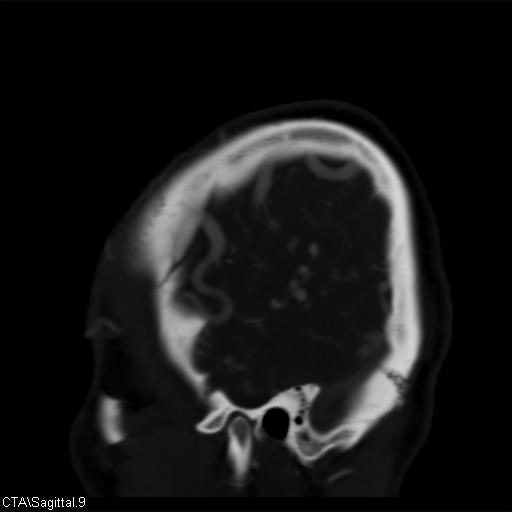 File:Cerebral arteriovenous malformation (Radiopaedia 28518-28759 D 6).jpg