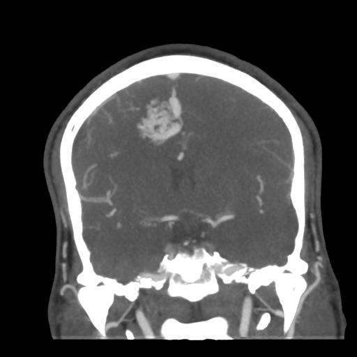 File:Cerebral arteriovenous malformation (Radiopaedia 39259-41505 E 31).png