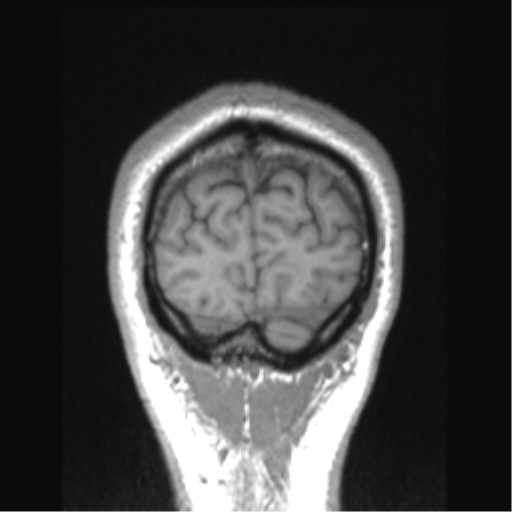 Cerebral arteriovenous malformation (Radiopaedia 39259-41506 Coronal T1 11).png
