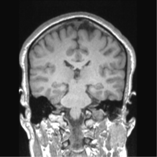 Cerebral arteriovenous malformation (Radiopaedia 39259-41506 Coronal T1 41).png