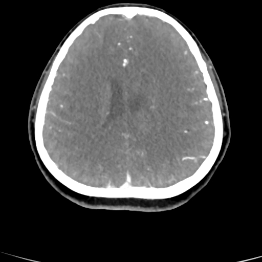 Cerebral arteriovenous malformation (Radiopaedia 73830-84645 B 37).jpg