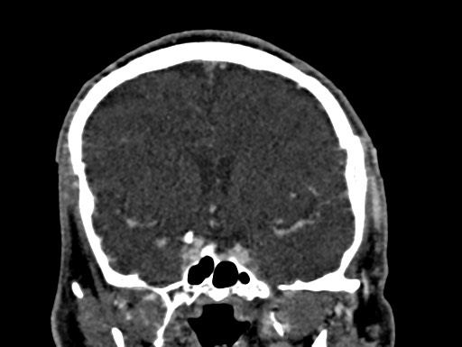 File:Cerebral arteriovenous malformation (Radiopaedia 78188-90746 Coronal C+ delayed 44).jpg