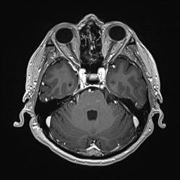 File:Cerebral arteriovenous malformation (Radiopaedia 84015-99245 Axial T1 C+ 53).jpg
